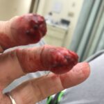 Two injured fingers with exposed tissue and heavy bleeding in a hospital room setting.